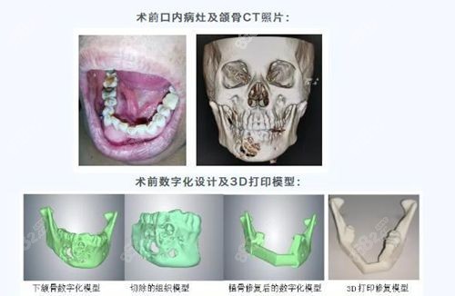 何晋龙下颌角修复怎么样www.8682.cc.jpg