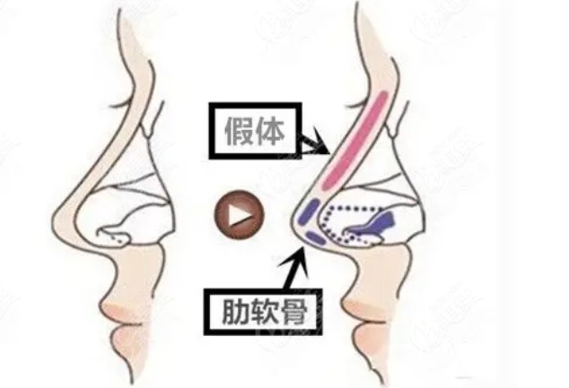 国内肋骨鼻修复好的医院