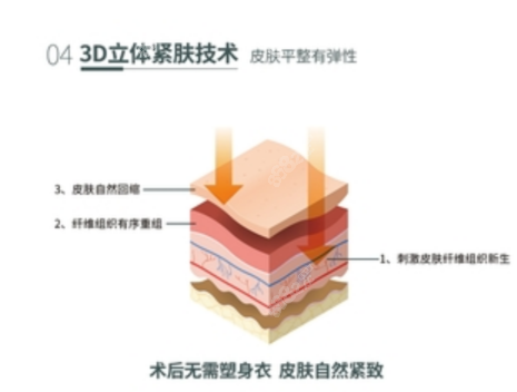 深圳曹孟君土麦森吸脂