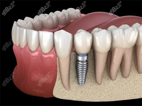 种植牙解剖图