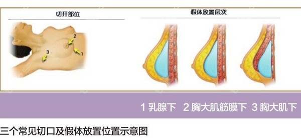 隆胸切口示意图