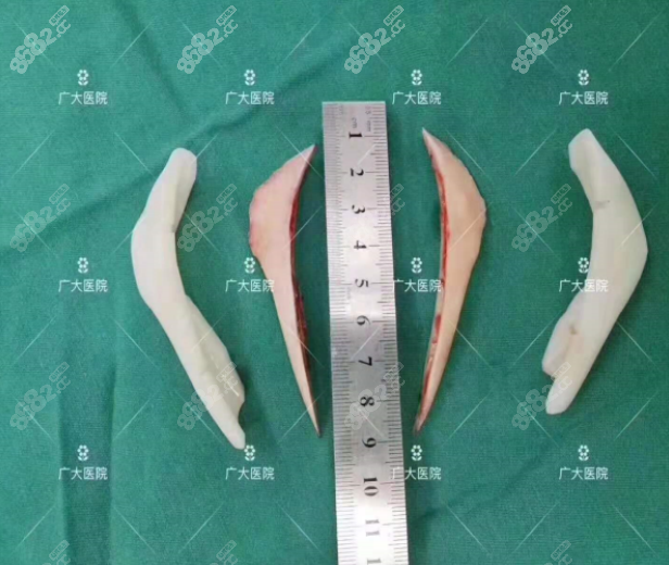 广州广大整形医院颌面手术