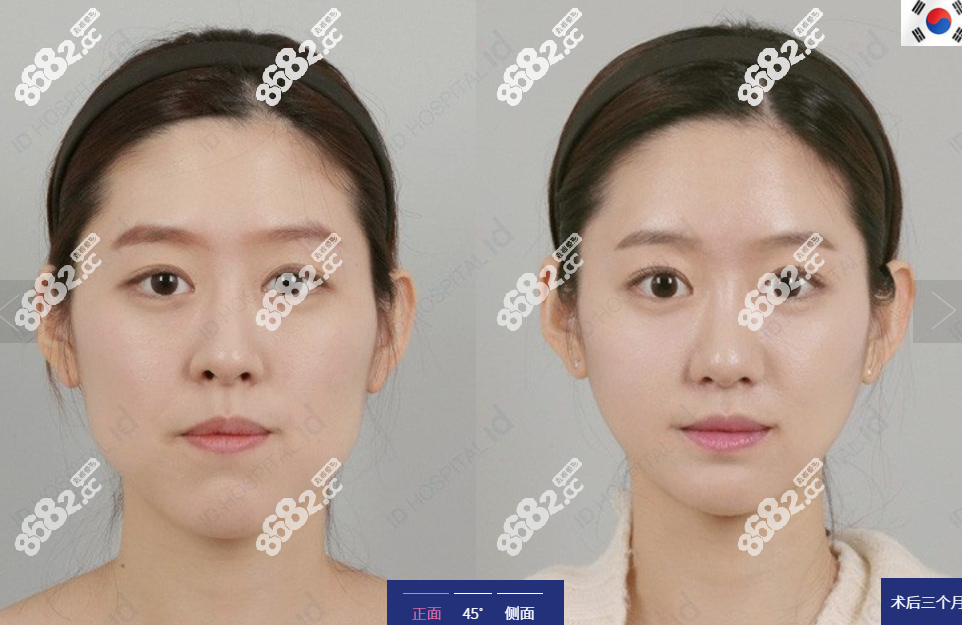 韩国id整形外科医院双鄂手术对比图