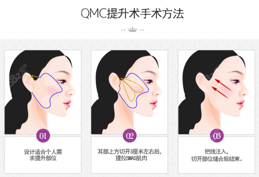 韩国必当归医院柳济圣的QMC面部提升技术