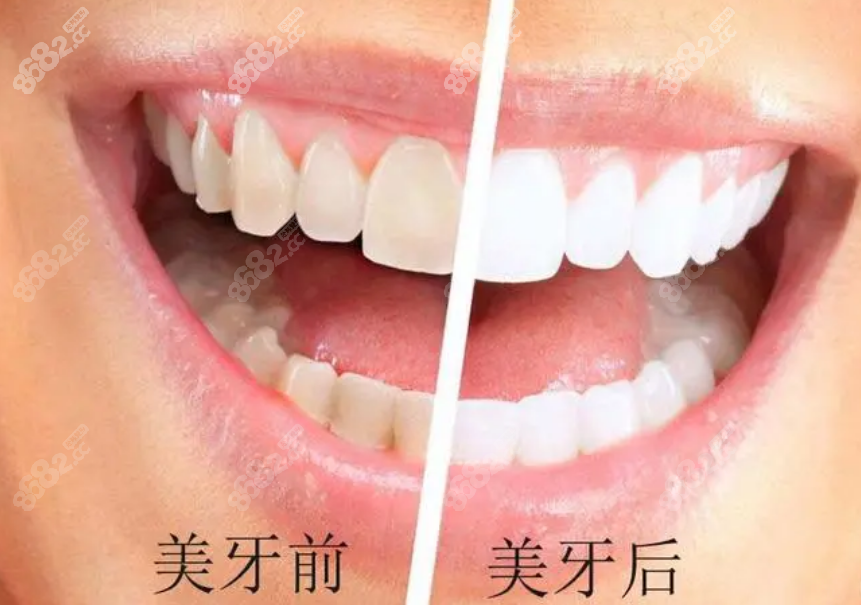 奉节口腔医院牙齿美白费用