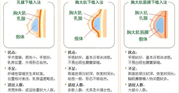 假体植入法