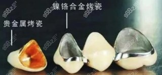 烤瓷牙