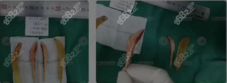 广州广大整形医院颌面手术