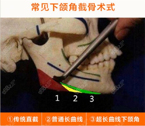 常见的下颌角截骨术式