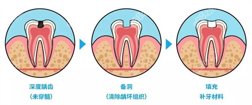 补牙流程图