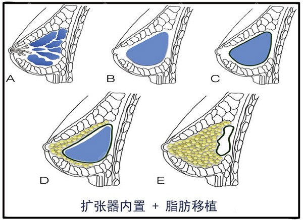 重庆华美整形外科医院胸部再造