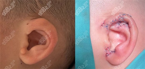 廣州余文林醫(yī)生耳再造技術(shù)