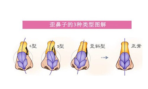 歪鼻矫正