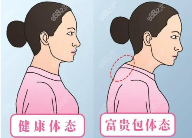 去除富贵包手术电动螺旋刀吸脂和克莱恩土麦森抽脂哪个好