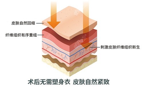 曹孟君吸脂真的不用穿塑身衣