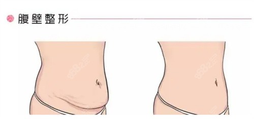 余文林腹壁成形如何？