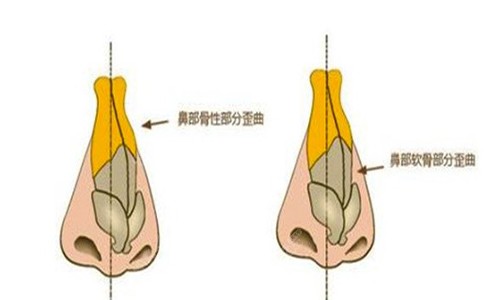 歪鼻矫正