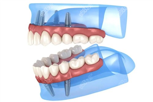 全口种植牙动画模拟图