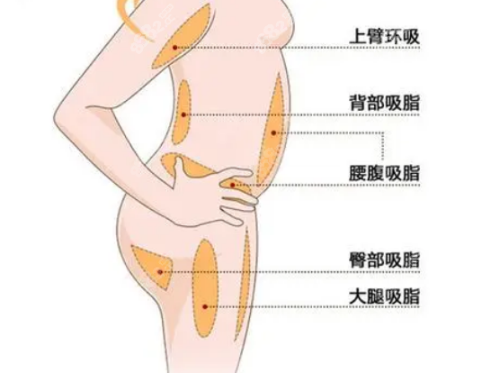 西安王爱武吸脂咋样