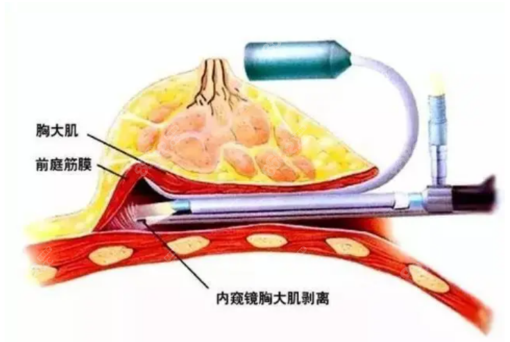 假体隆胸手术