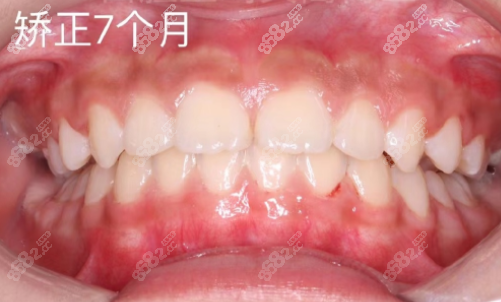 龅牙矫正后的照片