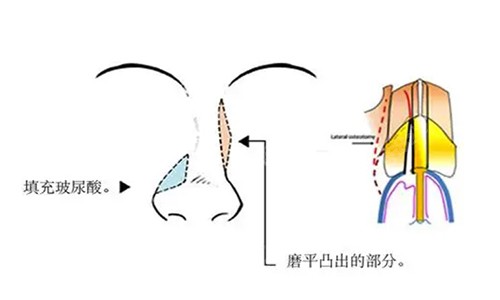 歪鼻矫正