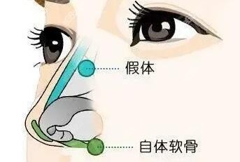 李劲良做鼻子口碑好吗