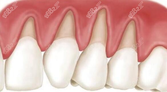如何防止牙龈瘪