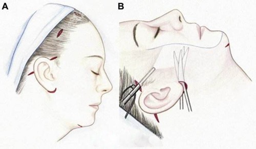 韩国珠儿丽拉皮提手术技术图