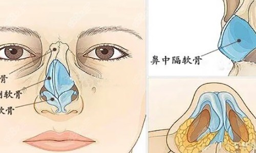 歪鼻矫正