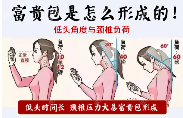 富贵包是怎样形成的