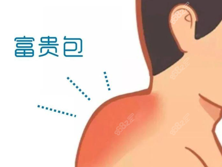 去除富贵包手术电动螺旋刀吸脂和克莱恩土麦森抽脂哪个好