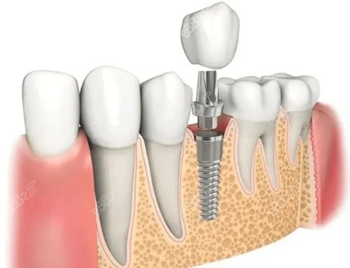 种植牙示意图