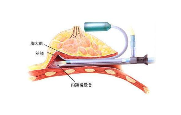 西安美莱假体隆胸技术如何