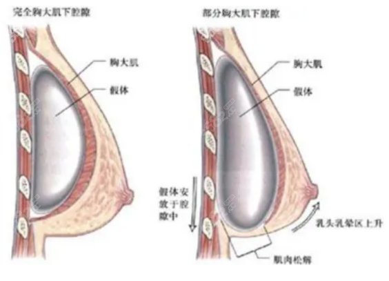 黄广香医生隆胸