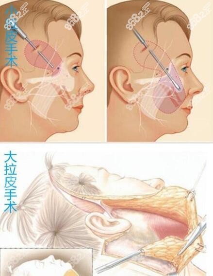 泰国然禧(Yanhee)整形医院拉皮好8682.cc