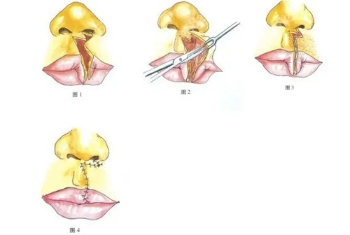 广州广大王政医生做唇腭裂手术好吗？