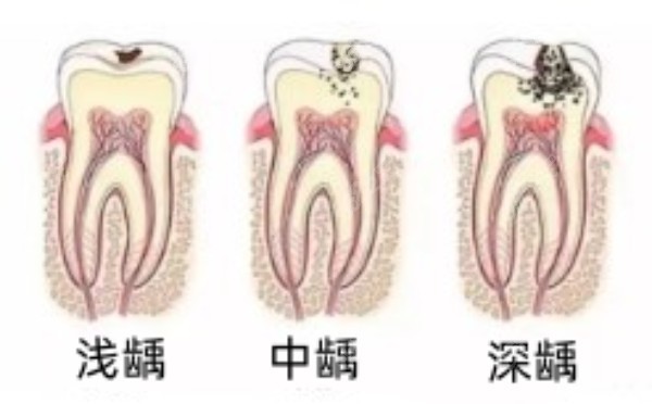 龋齿的种类