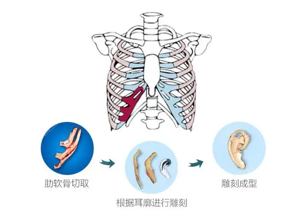 郑州中医药一附院做肋软骨外耳再造手术www.8682.cc