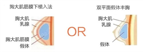 上海殷初阳医生内窥镜丰胸