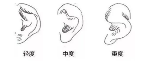 耳畸形程度不同郑州中医药一附院做耳朵整形价格不同