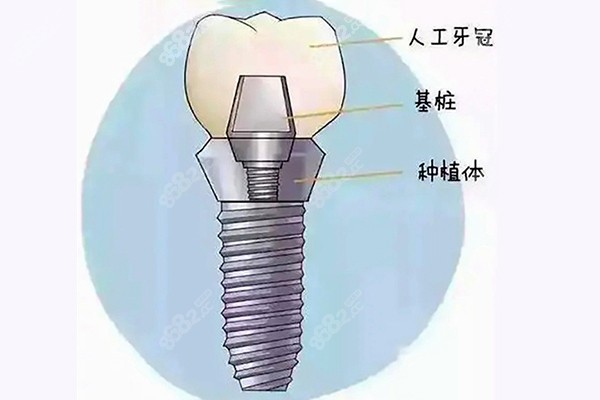 团圆口腔种牙价格