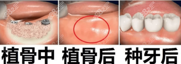 种植牙自体骨移植