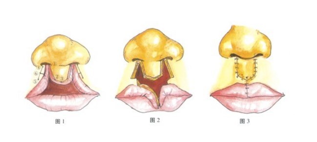 西安师俊莉唇裂修复实例