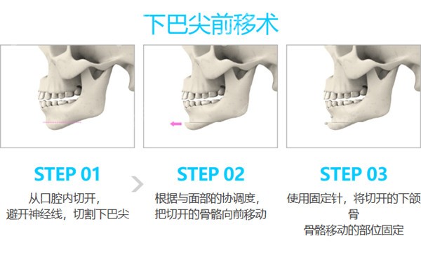 韩国歌柔飞整形医院做下巴手术优势8682.cc