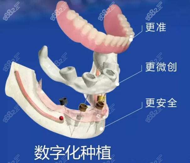 数字化种植技术