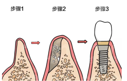 种植牙自体骨移植