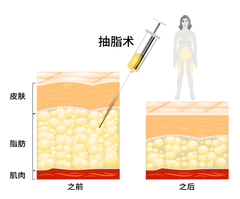 吸脂减肥全部过程