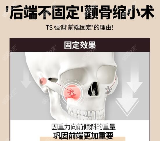 韩国ts整形外科医院术后真实记录