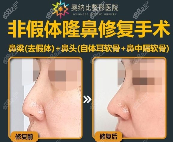韩国奥纳比非假体隆鼻修复手术